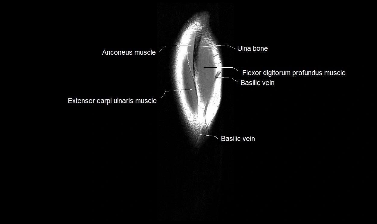 MRI 3T forearm coronal cross sectional anatomy image 27.webp